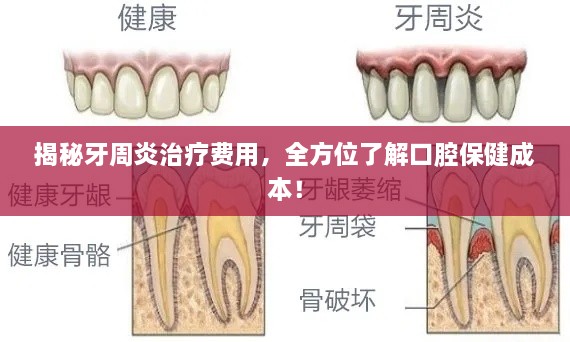 揭秘牙周炎治疗费用，全方位了解口腔保健成本！